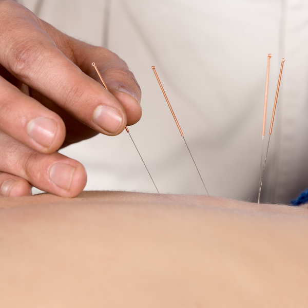 Acupuncture needles being inserted into a patient's lower back by a practitioner