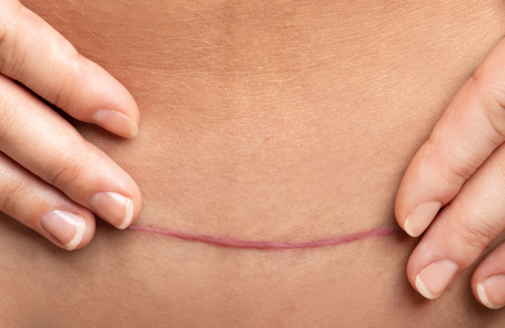 Close-up of a healed C-section scar on a woman's abdomen